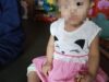 Seorang Anak Di Subang Menderita Penyakit Skabies