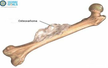 Gejala dan Penyebab Penyakit Osteosarkoma