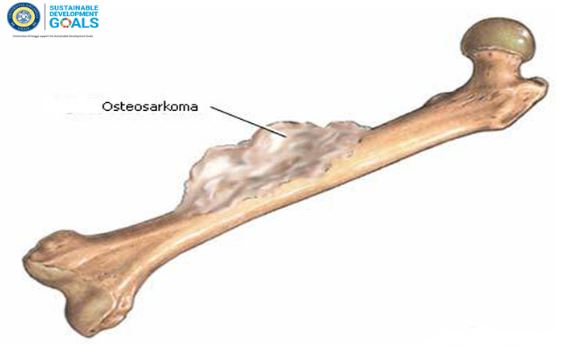 Gejala dan Penyebab Penyakit Osteosarkoma