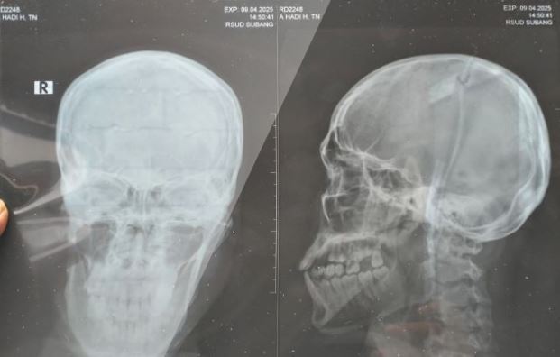 Hasil Visum Penganiayaan Jurnalis di Subang